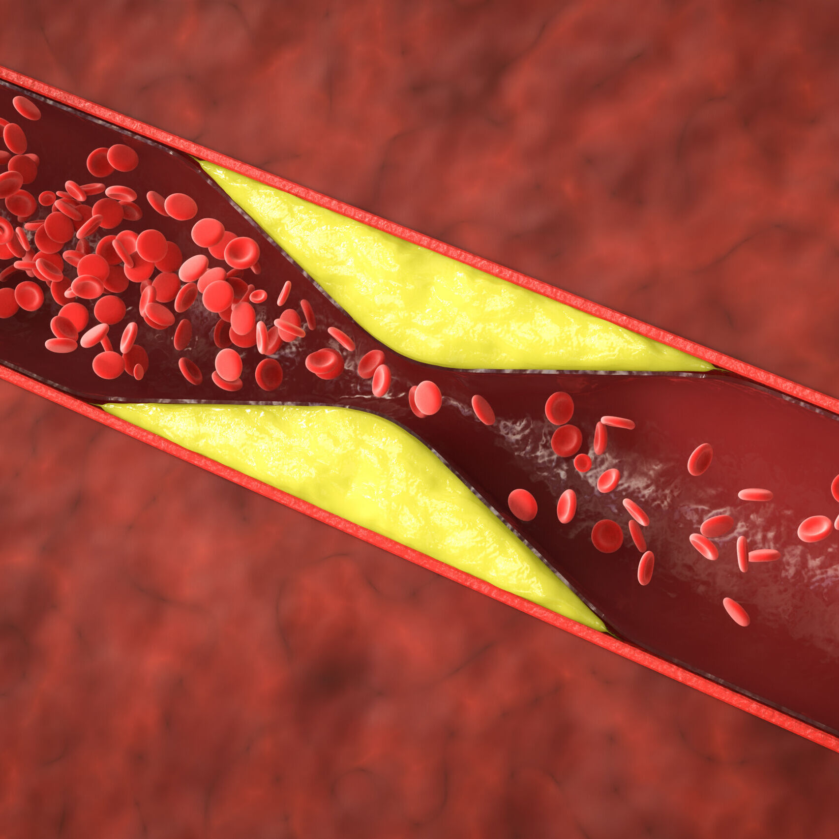 atherosclerosis with plaque in vessel