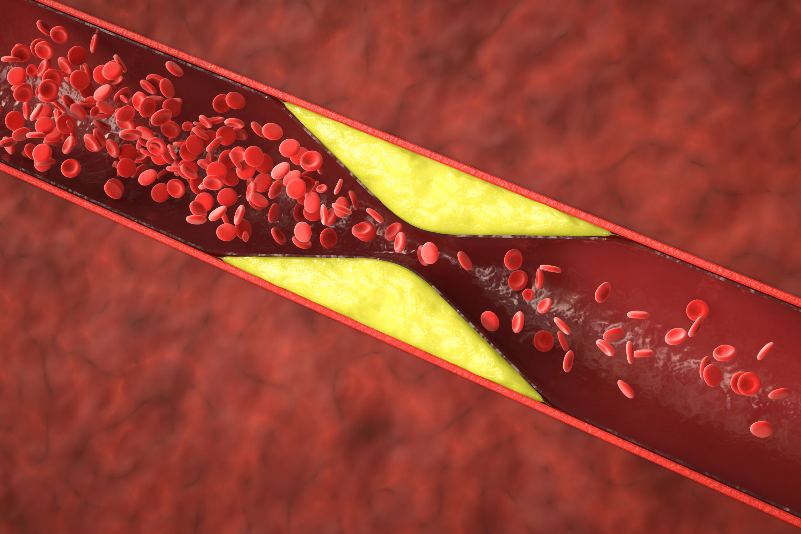 atherosclerosis with plaque in vessel